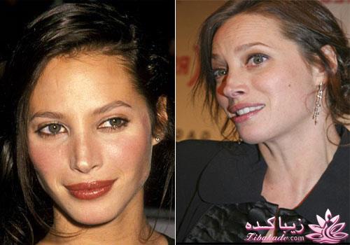 جراحی بینی - جراحی زیبایی